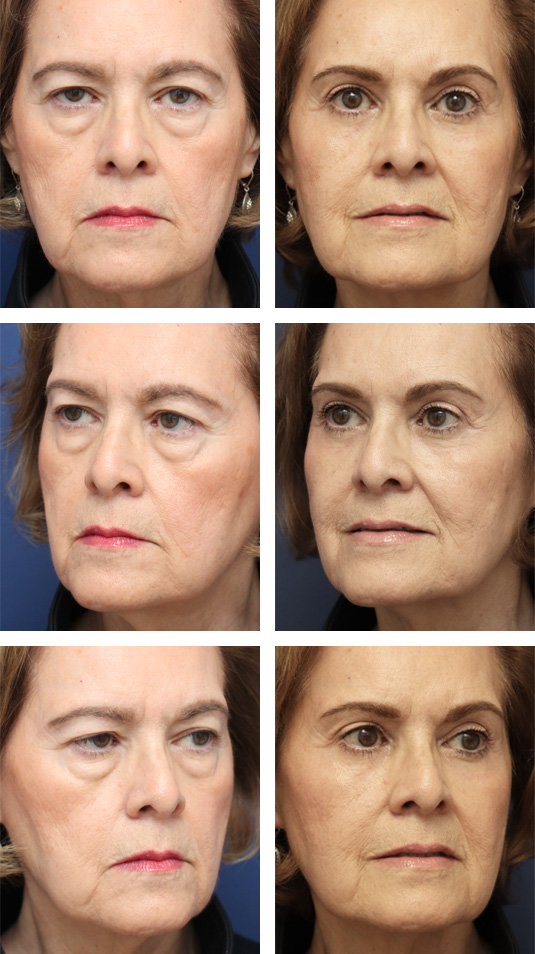  Before and After Picture 
70 Year Old Female – Upper and Lower Lid Blepharoplasty with Right Upper Lid Ptosis Repair, Injection of 5cc of Fat to Each Cheek, and Laser Skin Resurfacing. No Lower Lid Skin Incisions were made.