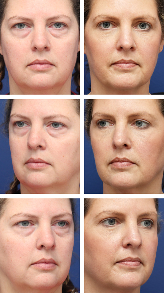  Before and After Picture 
42 Year Old Female – Upper and Lower Blepharoplasty with Periocular Laser Skin Resurfacing. No lower lid skin incisions were made.