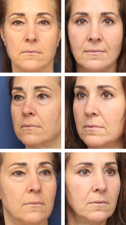  Before and After Picture  
56 Year Old Female – Upper and Lower Blepharoplasty with Periocular Laser Skin Resurfacing. No lower lid skin incisions were made.