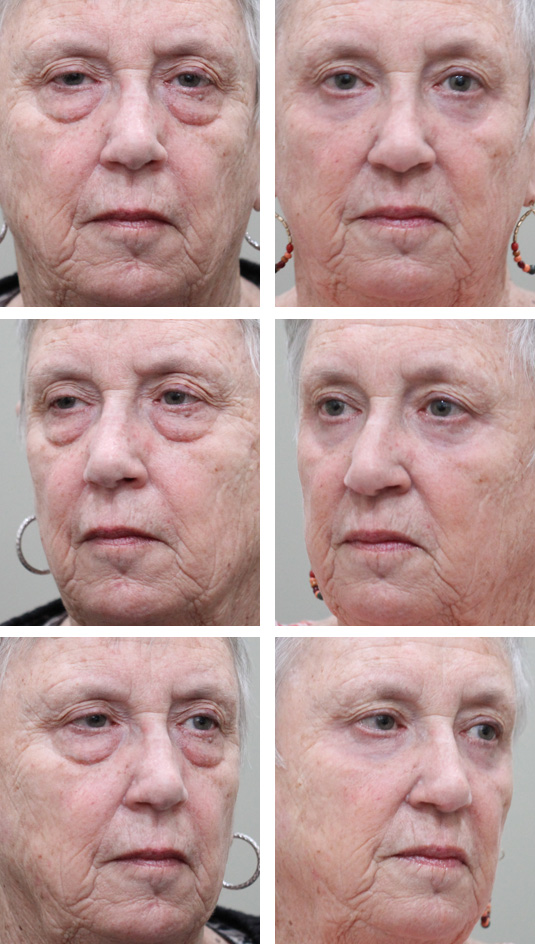  Before and After Picture 
74 Year Old Female – Bilateral Upper Lid Ptosis Repair with Lower Blepharoplasty and Periocular Laser Skin Resurfacing. No Skin Incisions.
