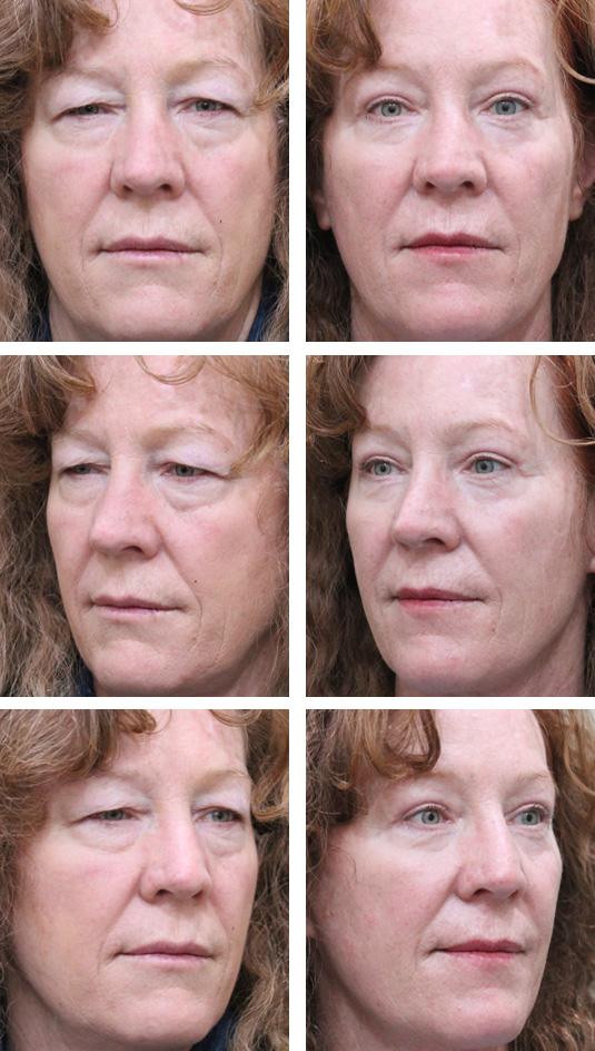  Before and After Picture 
64 Year Old Female – Upper blepharoplasty, Transconjunctival Lower Blepharoplasty with lower lid skin excision, Periocular Fractional CO2 Laser Skin Resurfacing.


