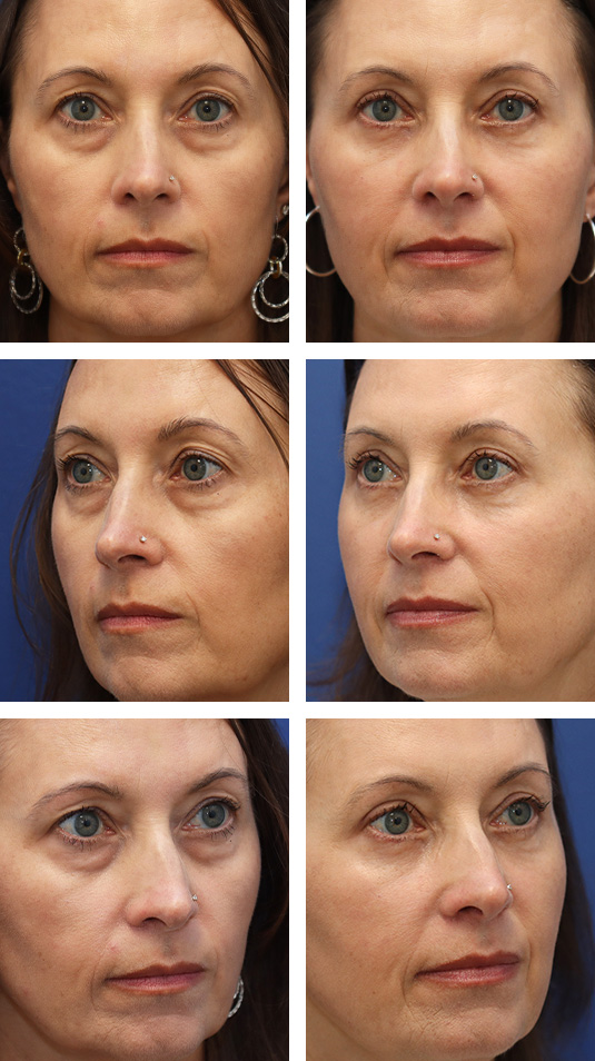  Before and After Picture 
54 Year Old Female – Upper and Lower Blepharoplasty with AccuTite Radiofrequency to Lower Lid Skin. A Lower Lid Skin Pinch Excision Was Performed.