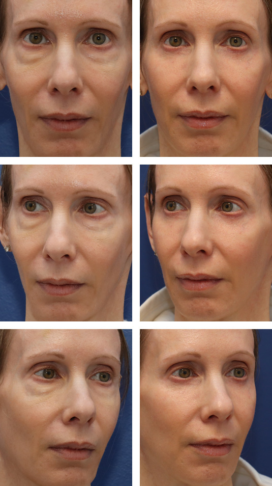 Before and After Picture
49 Year Old Female – Lower Lid Blepharoplasty with Fat Repositioning, Injection of 4cc of Fat to Each Cheek and Laser Skin Resurfacing. No Lower Lid Skin Incisions were made. Before and After Picture
49 Year Old Female – Lower Lid Blepharoplasty with Fat Repositioning, Injection of 4cc of Fat to Each Cheek and Laser Skin Resurfacing. No Lower Lid Skin Incisions were made.