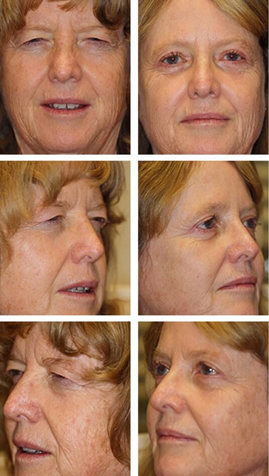  Before and After Picture 
59 Year Old Female – Brow Lift with Upper and Lower Blepharoplasty