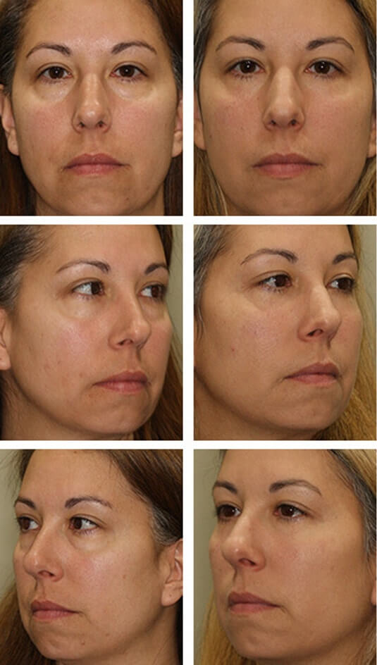  Before and After Picture 
42 Year Old Female – Lower blepharoplasty with Periocular Laser Skin Resurfacing