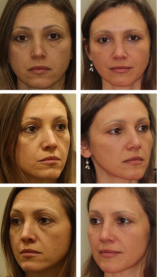  Before and After Picture  
46 Year Old Female – Lower Blepharoplasty with Periocular Laser Skin Resurfacing