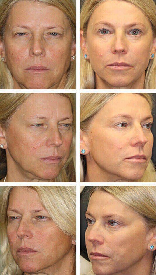  Before and After Picture 
54 Year Old Female – Brow Lift, Upper and Lower Blepharoplasty, and Periocular Laser Skin Resurfacing