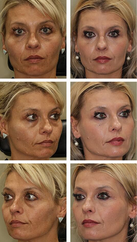  Before and After Picture 
45 Year Old Female: Lower Blepharoplasty with Periocular Laser Skin Resurfacing