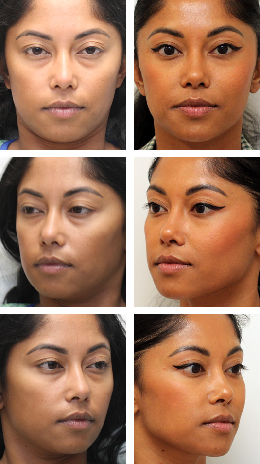  Before and After Picture 
33 Year Old Female – Lower Blepharoplasty with Left Upper Lid Ptosis Repair. No Skin Incisions.