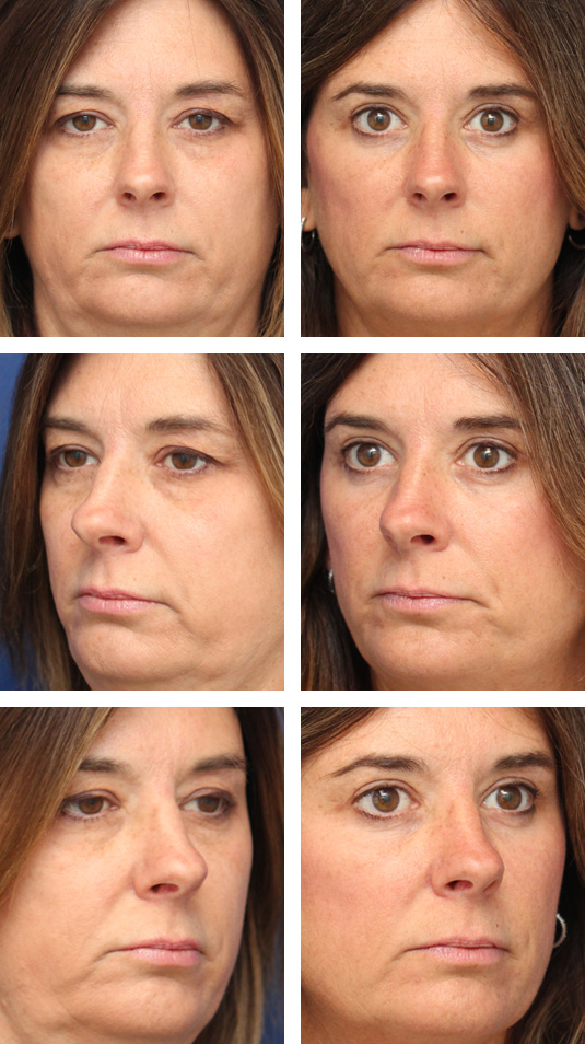  Before and After Picture 
45 Year Old Female – Upper and Lower Blepharoplasty with Periocular Laser Skin Resurfacing and Bilateral Upper Lid Ptosis Repair (tightening of the lid lifting muscle). No lower lid skin incisions were made.