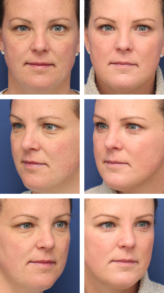  Before and After Picture 
38 Year Old Female – Lower Blepharoplasty with Periocular Laser Skin Resurfacing. A small strip of lower lid skin was excised.