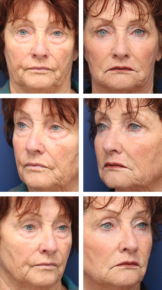  Before and After Picture 
71 Year Old Female – Lower Blepharoplasty with Periocular Laser Skin Resurfacing. No lower lid skin incisions were made.