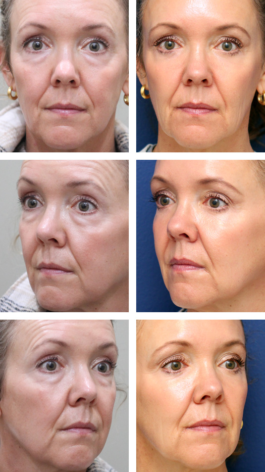  Before and After Picture 
50 Year Old Female – Upper and Lower Blepharoplasty with Periocular Laser Skin Resurfacing. No lower lid skin incisions were made.