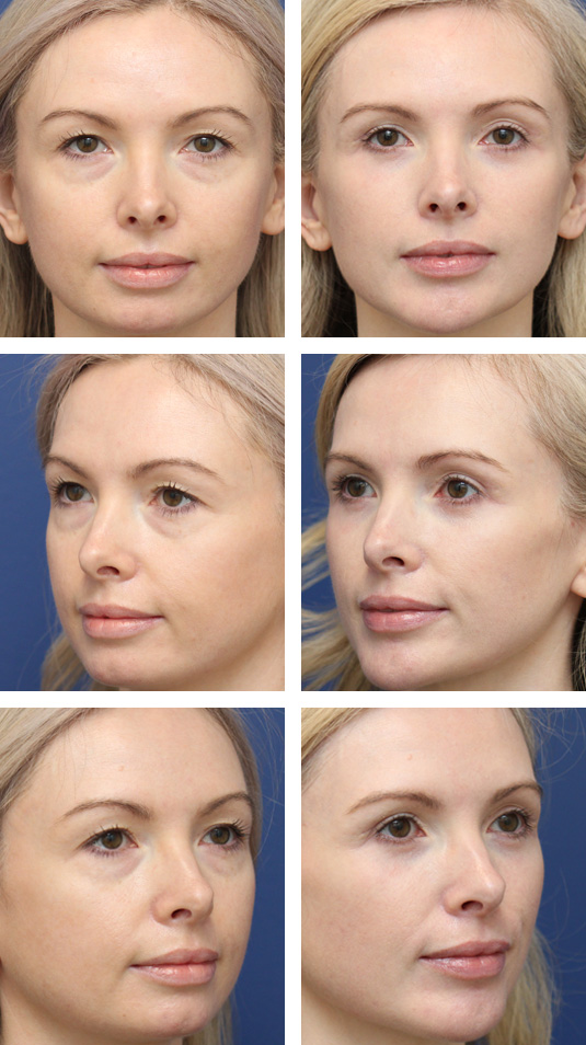  Before and After Picture 
36 Year Old Female – Upper and Lower Blepharoplasty with Periocular Laser Skin Resurfacing. No lower lid skin incisions were made.
