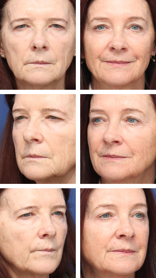  Before and After Picture 
69 Year Old Female – Brow Lift via Hairline Incision.  This patient did not desire an upper blepharoplasty, so no upper lid skin was removed.  Lifting the brow did elevate the upper lid skin and help with upper lid heaviness (although removing upper lid skin would have opened the eyes up more).