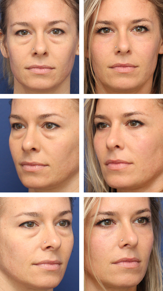  Before and After Picture 
39 Year Old Female – Lower Blepharoplasty with Periocular Laser Skin Resurfacing. No lower lid skin incisions were made.