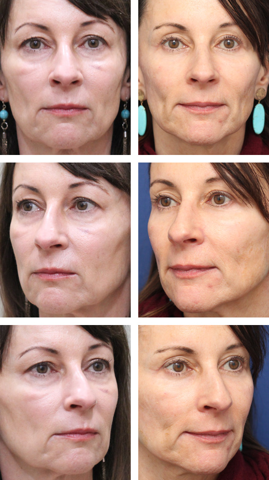  Before and After Picture 
54 Year Old Female – Upper and Lower Blepharoplasty with Morpheus8 Radiofrequency Microneedling to Malar Mounds(cheek swelling below the lower lids). No lower lid skin incisions were made.