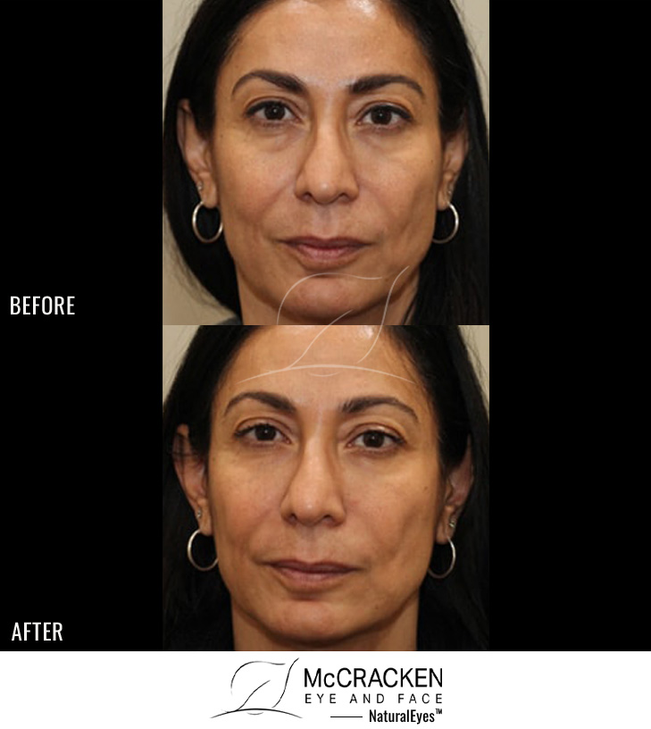 49 Year Old Female – Restylane to Tear Troughs and Nasolabial Folds