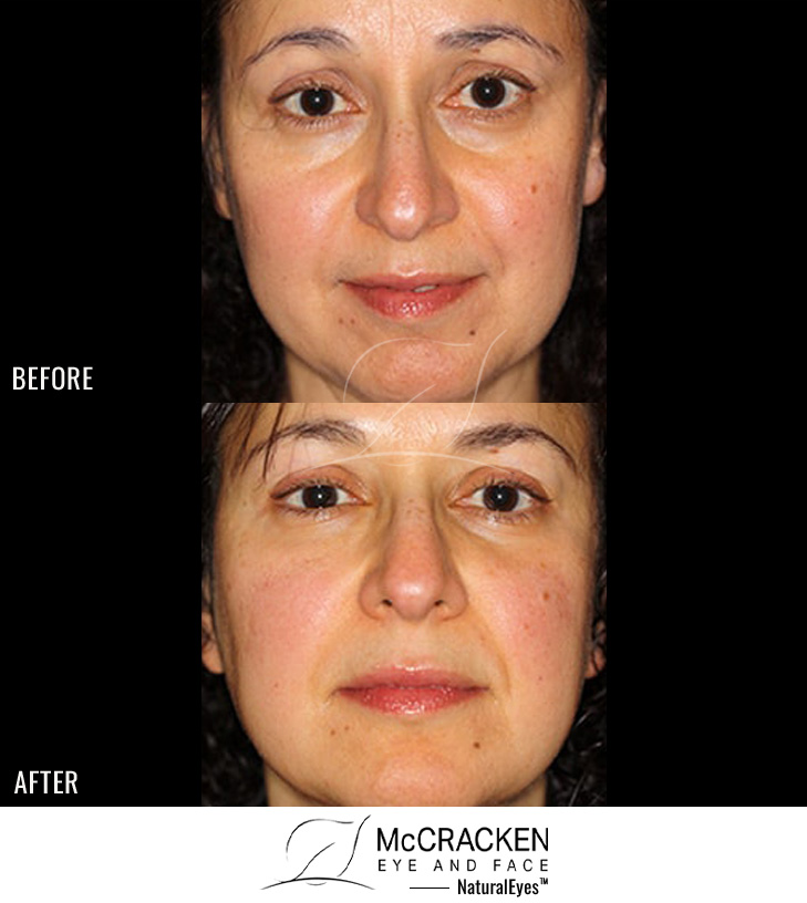 50 Year Old Female – Restylane to Lower Lids and Nasolabial Folds
