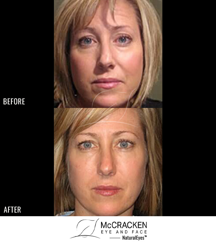 43 Year Old Female – Restylane to Lower Lids