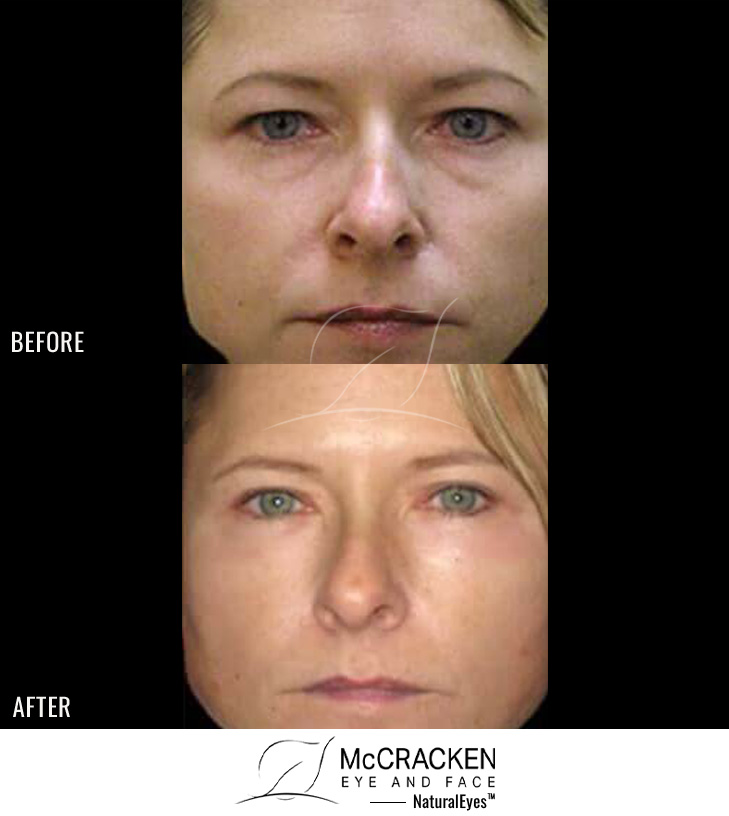 36 Year Old Female – Upper Blepharoplasty (Upper Eyelid Surgery), Lower Eyelid Resurfacing and Lower Eyelid Restylane®