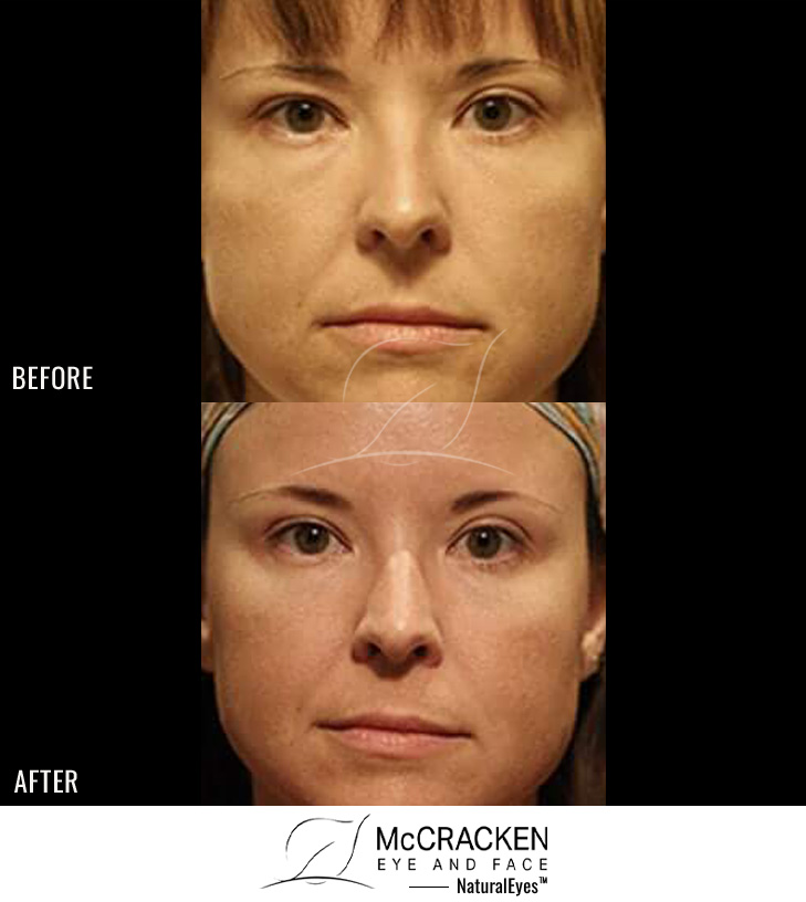 38 Year Old Female – Restylane to Lower Lids