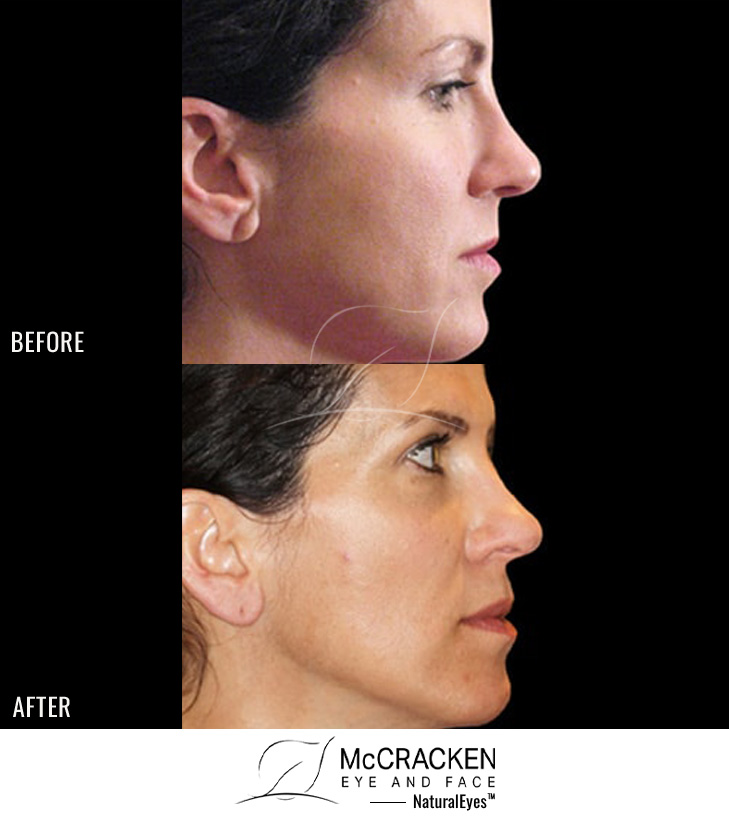 29 Year Old Female – Restylane® to Earlobes