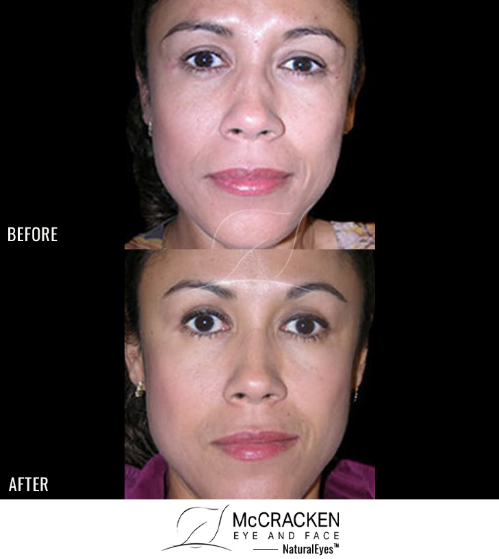 41 Year Old Female – Restylane® to Nasolabial Fold
