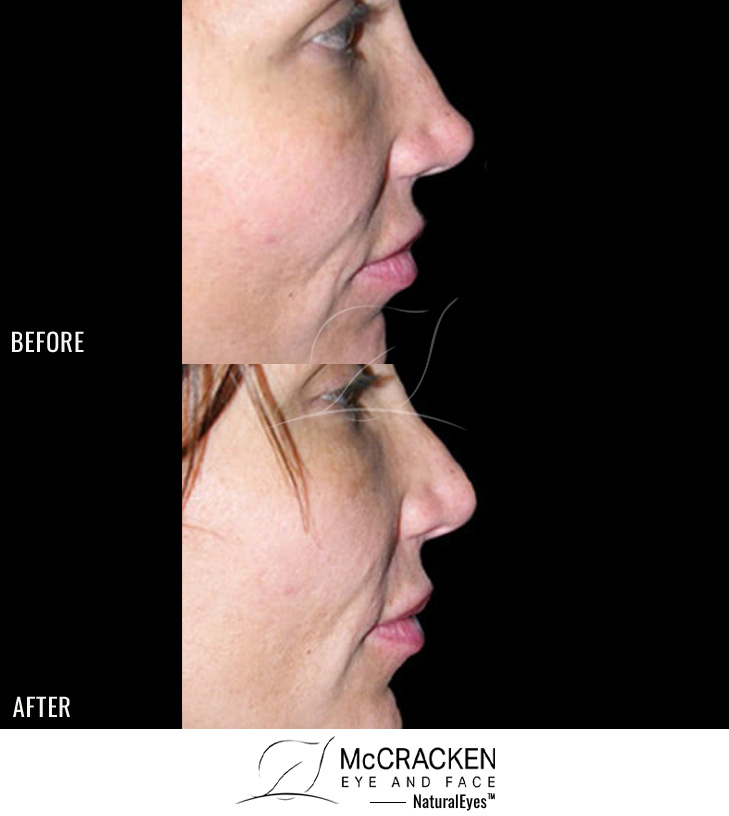 Female with Restylane® to Nose
