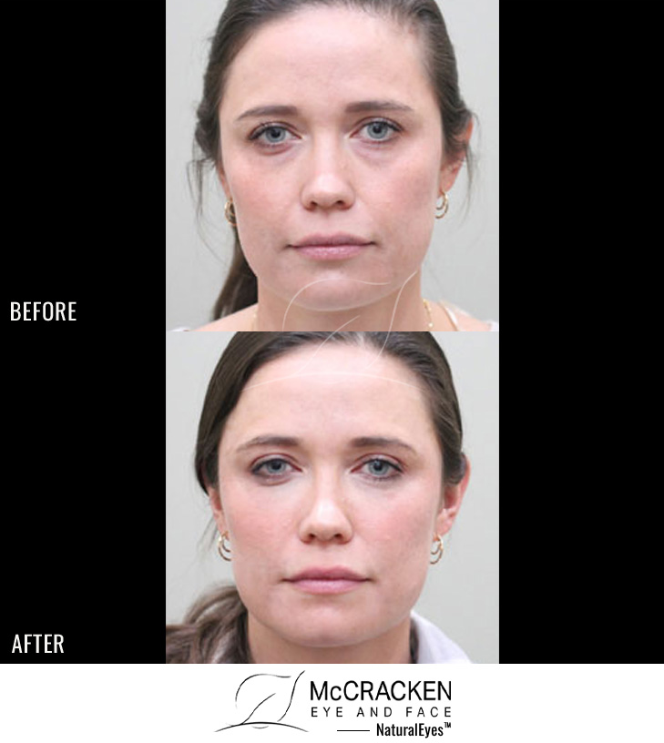 29 Year Old Female – Bilateral Lower Lid Restylane Injection for Lower Eyelid Bags