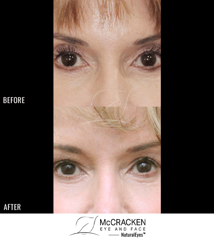 73 year old female – Bilateral upper lid Restylane injection to correct upper lid hollowness
