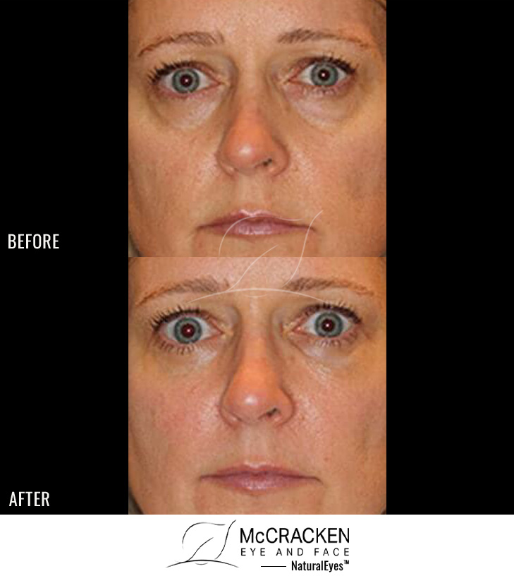 47 Year Old Female – Bilateral Lower Lid Restylane