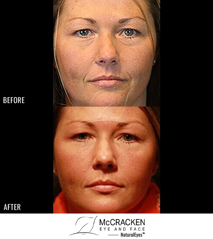 37 Year Old Female – Bilateral Lower Lid Restylane
