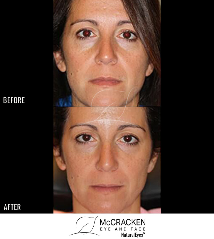 38 Year Old Female – Bilateral Lower Lid Restylane