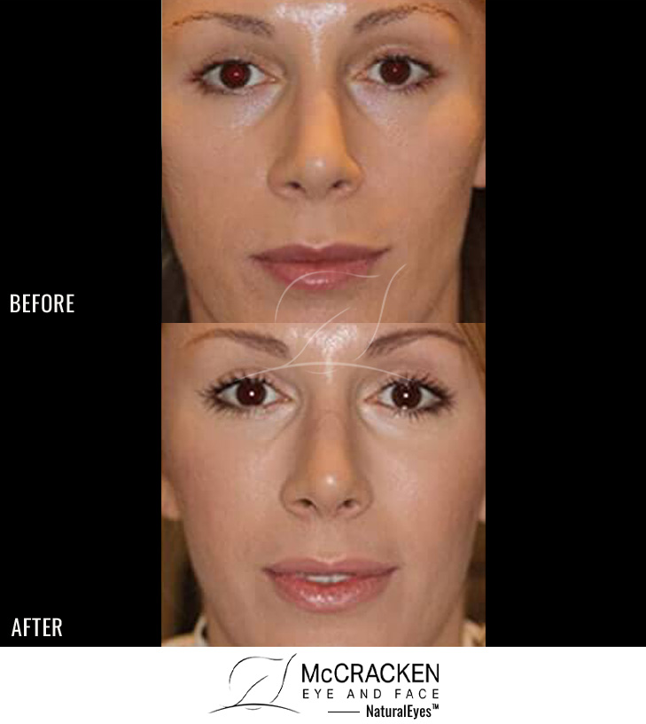 28 Year Old Female – Bilateral Lower Lid Restylane and Bilateral Cheek Perlane