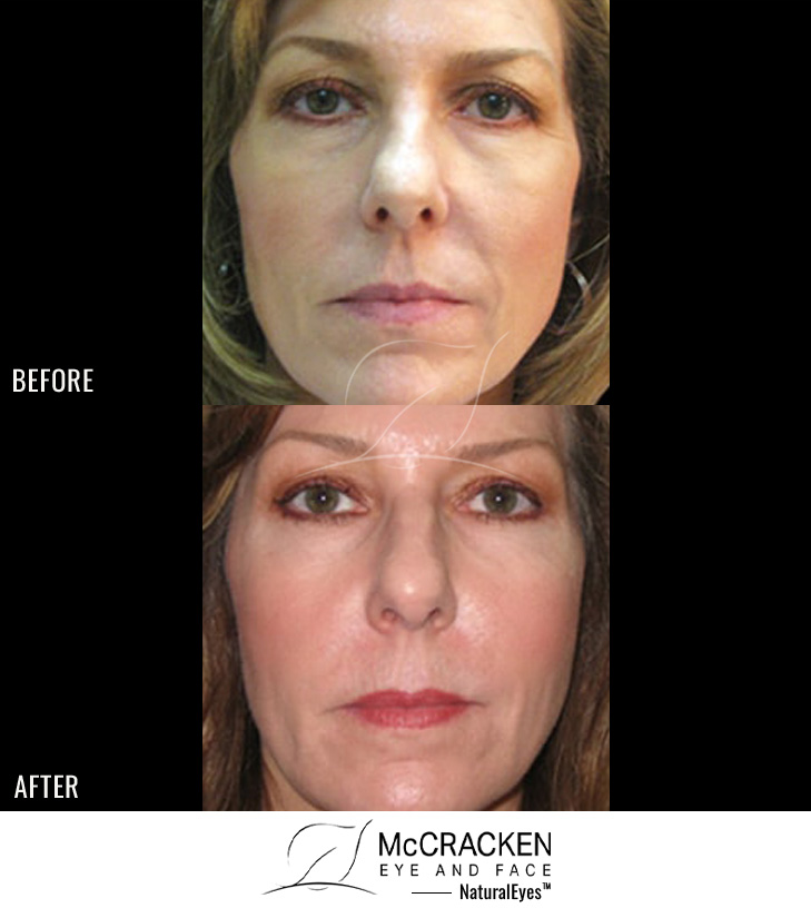 48 Year Old Female – Restylane® to Tear Trough