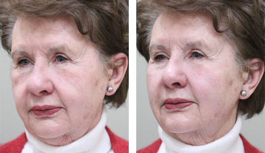  Before and After Picture 
83 Year Old Female – Cheek Augmentation with 3 Syringes of Voluma