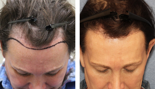  Before and After Picture 
49 year old patient, 10 months after 1090 grafts to the hairline.