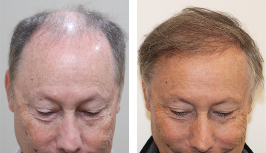  Before and After Picture 
67 year old patient, 1 year after 2500 grafts to the hairline.