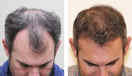  Before and After Picture 
44 year old male, 1 year after 2000 grafts to the hairline and crown.