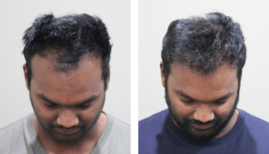  Before and After Picture 
30 year old male,1 year after 2013 grafts to the hairline and crown.