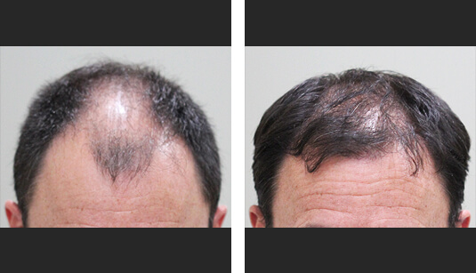  Before and After Picture 
49 year old male,1 year after 2678 grafts to the hairline and top of the scalp.