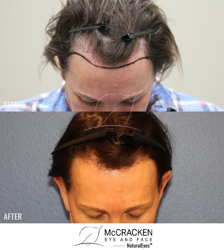 49 year old patient, 10 months after 1090 grafts to the hairline.
