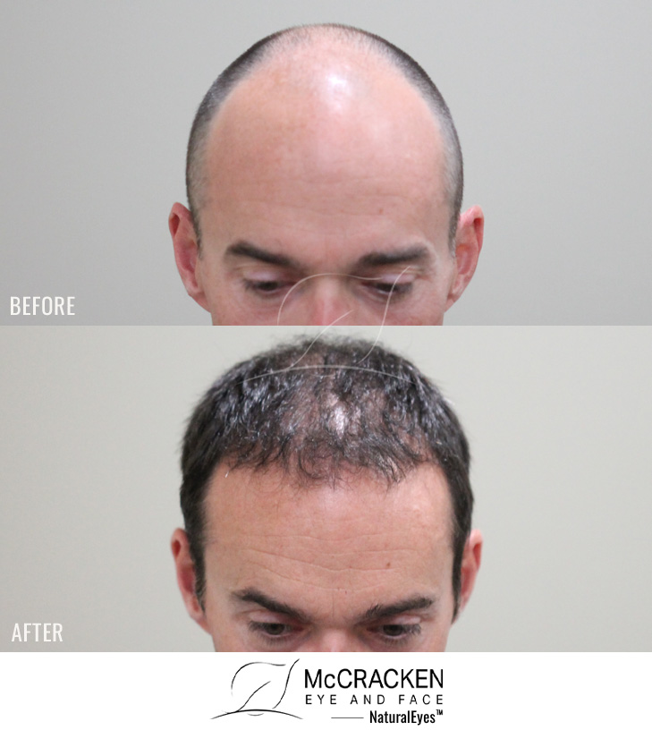 43 Year old male, 7 months after 3000 grafts to hairline and crown.