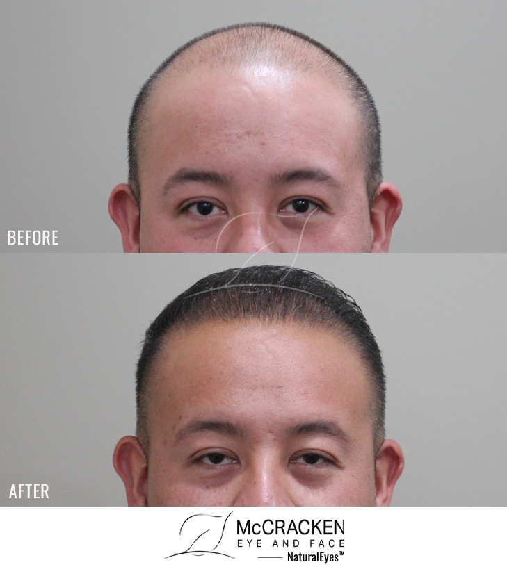 35 year old male, 6 months after 3000 grafts to the hairline and top of the scalp.