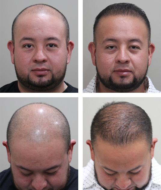  Before and After Picture  
35 year old male, 6 months after 3000 grafts to the hairline and top of the scalp.