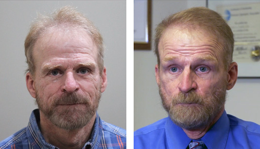  Before and After Picture 
62 Year Old Male, 2 1/2 years after 1517 grafts