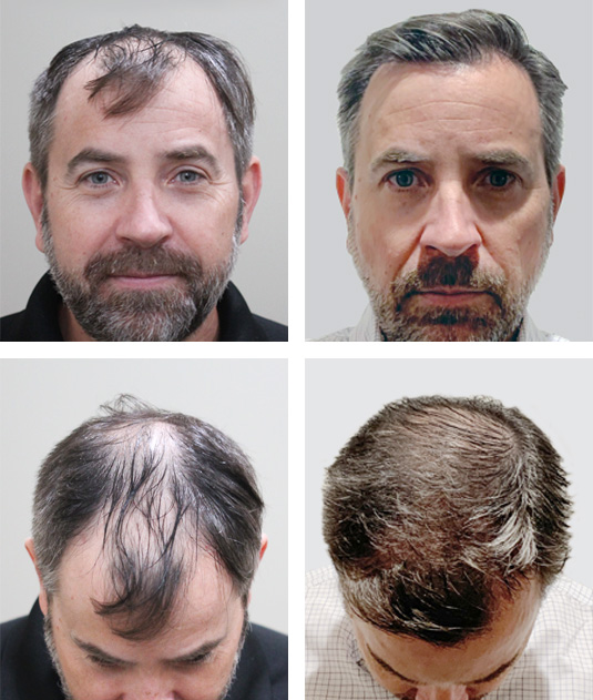  Before and After Picture 
49 year old male, 1 year after 2522 grafts to the hairline and crown.