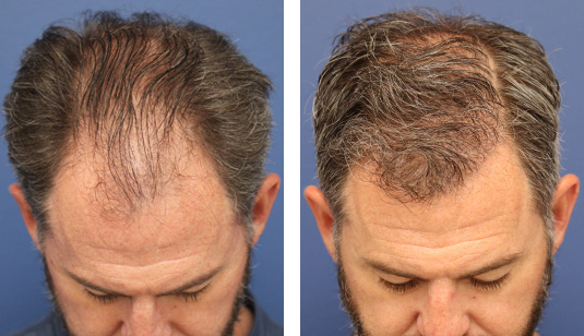  Before and After Picture 
47 year old male, 7 months after FUE transplant; 3000 grafts to the hairline and midscalp.
