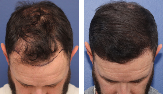  Before and After Picture 
40 year old male, 1 year after FUE transplant; 2500 grafts to the hairline and crown.